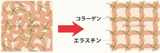 萎縮・癒着し歪んだ筋膜